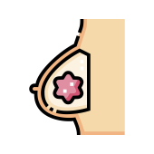 មហារីកសុដន់
